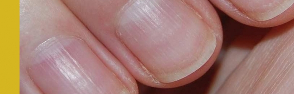 вертикальные линии на ногтях, болезни по ногтям
